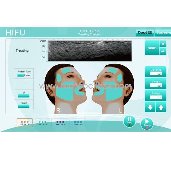 DOBLE TECHNIX TB (HIFU + LIPOSONIX) - Imagen 3