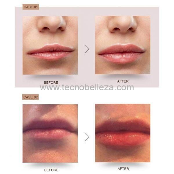 Hyaluronic pen TB - Imagen 4