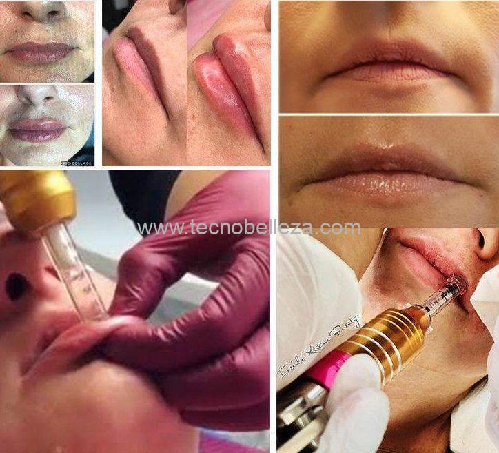 Hyaluronic pen TB - Imagen 3